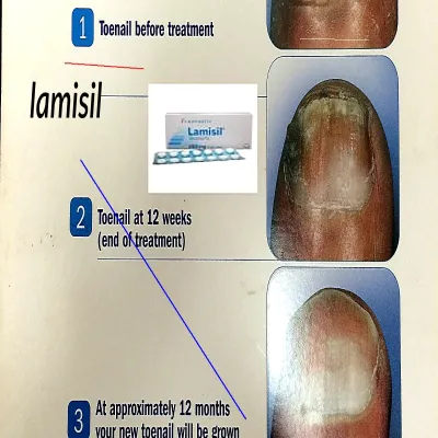 Lamisil prix maroc